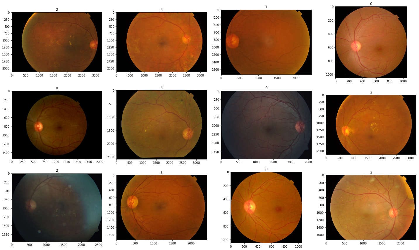 Images of Retina findings for training a classifier