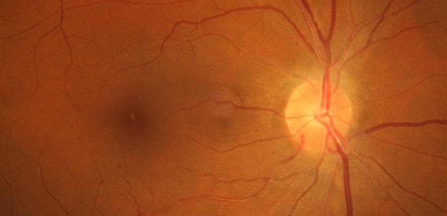 Retina Fundus by Frank Wood on Wikipedia with moderate retinopathy symptoms