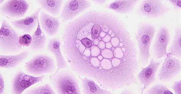 Classifiying Gene Mutations