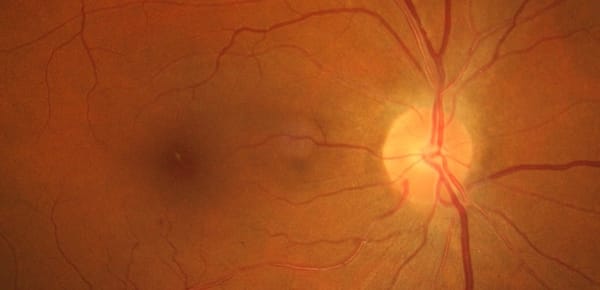 Retina Fundus by Frank Wood on Wikipedia with moderate retinopathy symptoms
