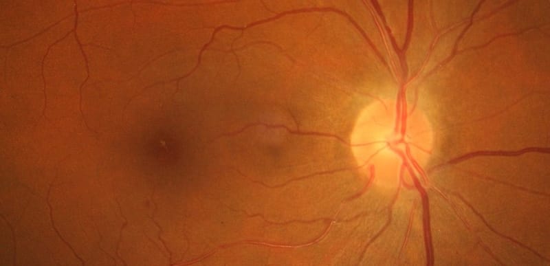 Retina Fundus by Frank Wood on Wikipedia with moderate retinopathy symptoms